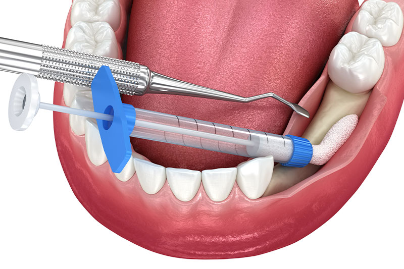Bone Grafting in Commack