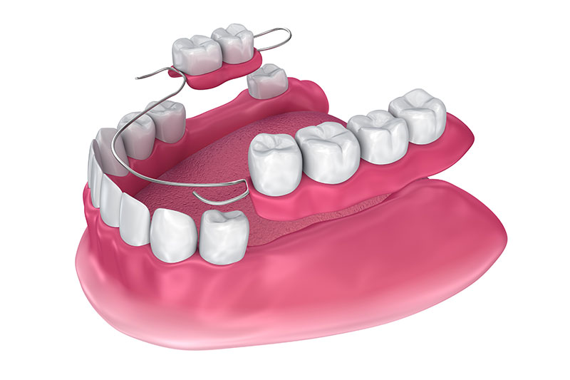 Full and Partial Dentures in Commack