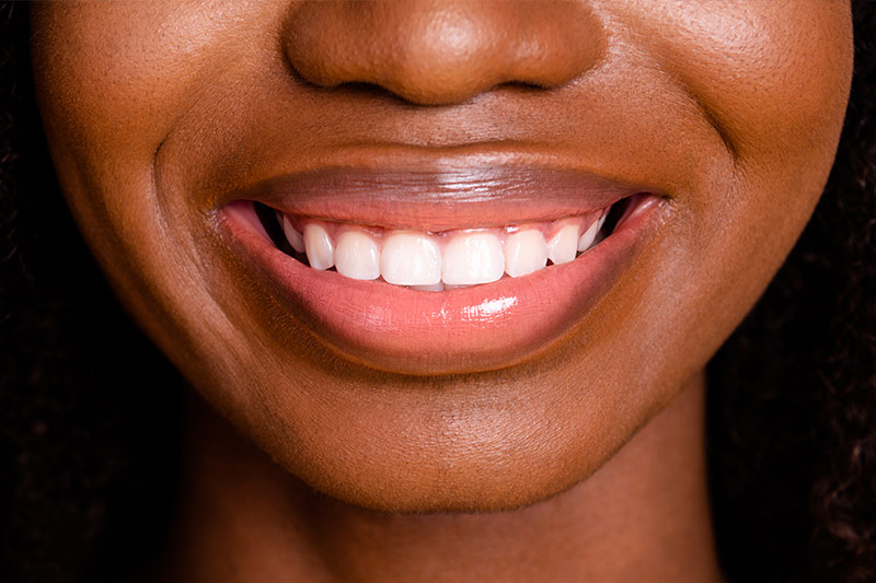 Gum Contouring in Commack